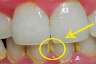 Przeczytaj jak pozbyć się kamieia z zębów w 5 minut naturalnymi składnikami! Bez wizyty u dentysty!